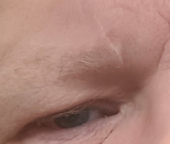 scar